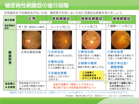 糖尿病性網膜症の進行段階